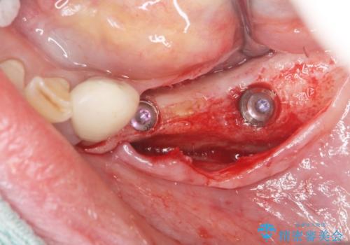 入れ歯で食事が楽しくなくなった。インプラントでまたしっかりとかみたいの治療前