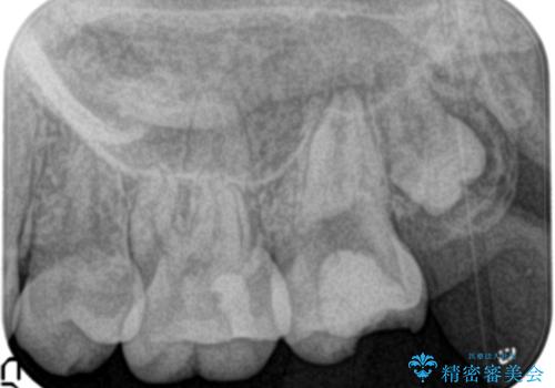 奥歯が痛い。ラバーダム使った治療がしたい。の治療前