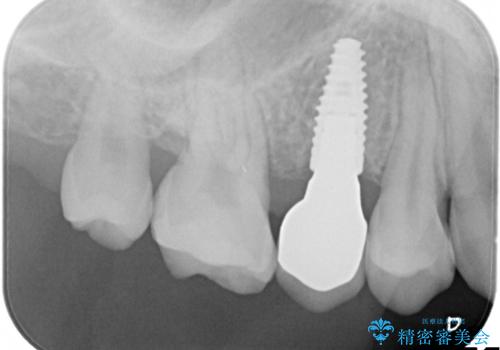隙間が気になる。審美性の高いインプラント治療の治療後
