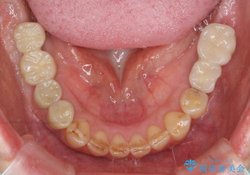 痛くて噛めない インプラントで全て治療したいの治療後