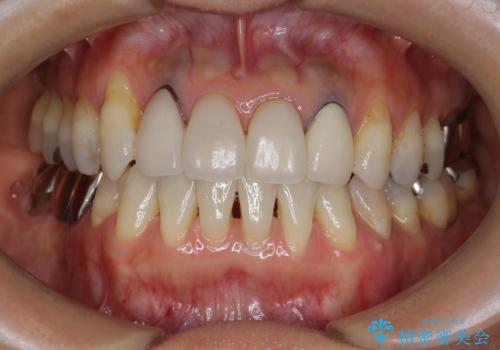 歯ぐきの黒ずみ クラウンやりかえによる改善の治療前