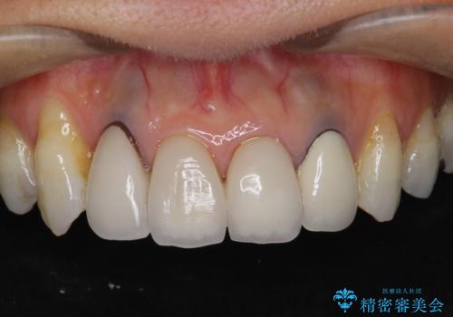 歯ぐきの黒ずみ クラウンやりかえによる改善の治療前