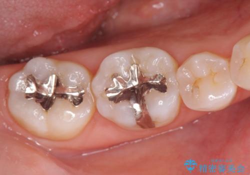 精密かつ審美的なセラミックインレーの治療前