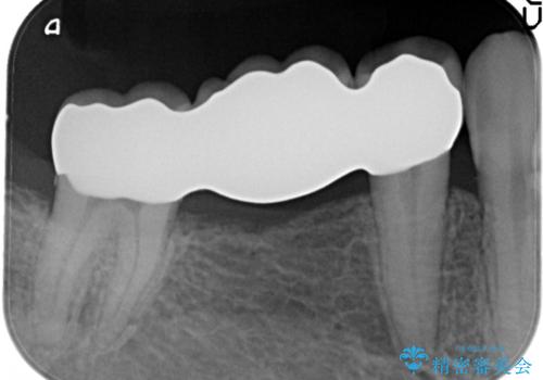 奥歯が痛い。ブリッジによる欠損補綴の治療後