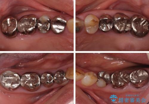 全ての奥歯の銀歯をセラミックに　メタルフリー治療の治療前