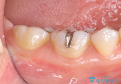 精密かつ審美的なセラミックインレーの治療前