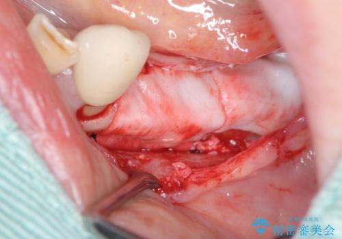 入れ歯で食事が楽しくなくなった。インプラントでまたしっかりとかみたいの治療前