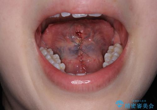 舌小帯の形成の治療中