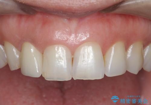 前歯の違和感　失活歯の根管治療とセラミック治療の治療後