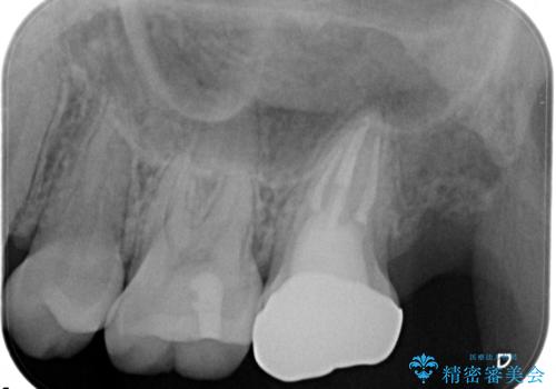 奥歯が痛い。ラバーダム使った治療がしたい。の治療後