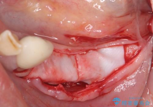 入れ歯で食事が楽しくなくなった。インプラントでまたしっかりとかみたいの治療前
