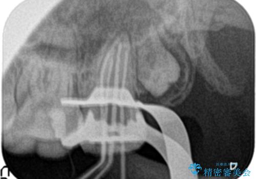 奥歯が痛い。ラバーダム使った治療がしたい。の治療中