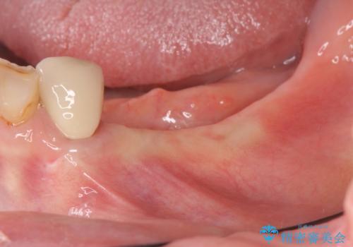 入れ歯で食事が楽しくなくなった。インプラントでまたしっかりとかみたいの治療中