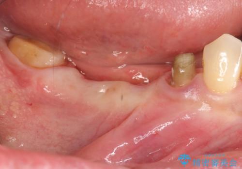 銀歯だらけの口の中を改善したいの治療中
