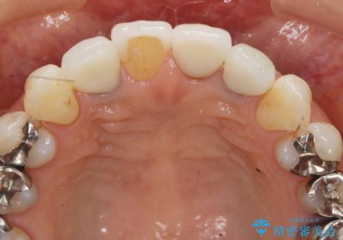 歯ぐきの黒ずみ クラウンやりかえによる改善の治療後