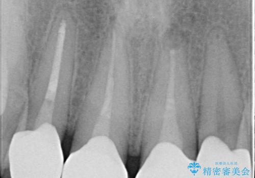 昔装着したかぶせ物を自然な色にしたい オールセラミックによる審美的改善の治療後
