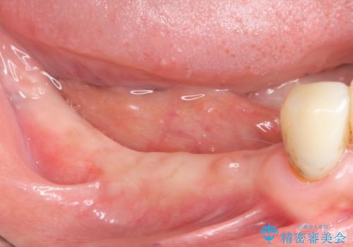 奥歯のインプラント治療の治療前