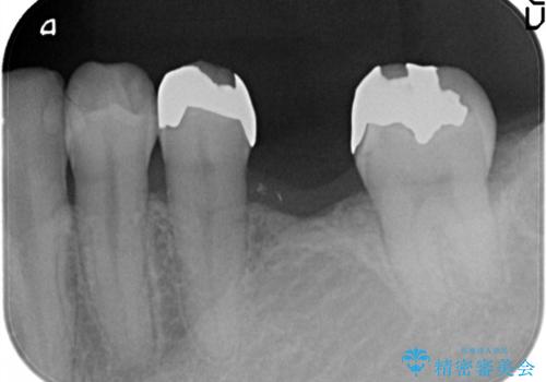 奥歯で噛めるようになりたい。オールセラミッククラウンブリッジの治療前