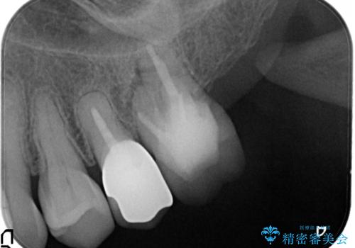 金属のかぶせ物をセラミックへ 根管治療からの再治療の治療後