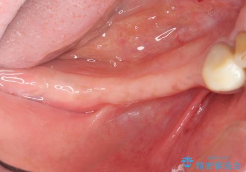 奥歯のインプラント治療の治療前