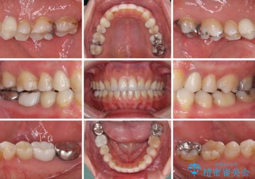 総合歯科治療　矯正治療と失活歯のセラミック補綴治療の治療後