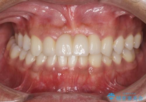 [前歯の歯根吸収]　前歯審美セラミックブリッジの製作の治療後