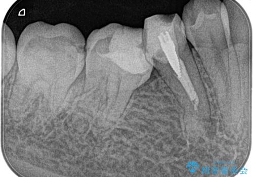 【湾曲根管】奥歯がズキズキ痛い の症例 治療前