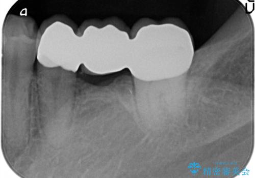 奥歯で噛めるようになりたい。オールセラミッククラウンブリッジの治療後