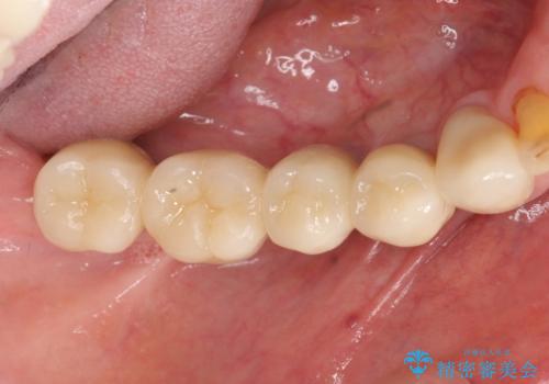 奥歯のインプラント治療の治療後