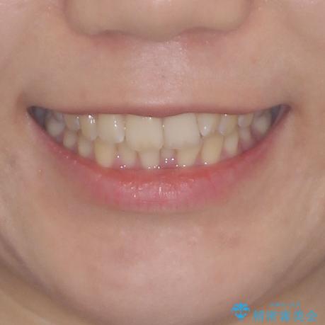 前歯のデコボコを解消　インビザラインによる矯正治療の治療前（顔貌）