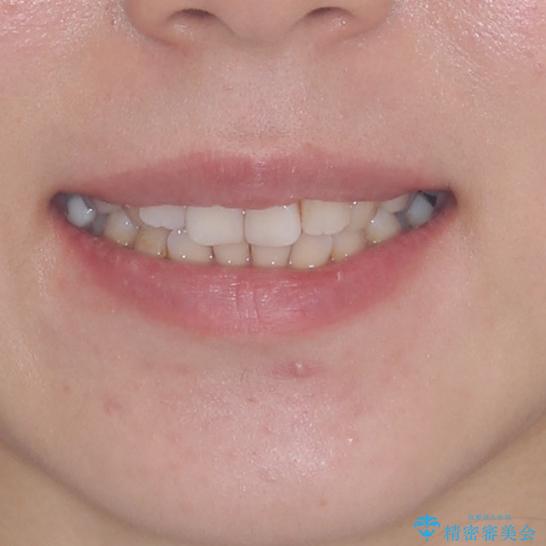 総合歯科治療　矯正治療と失活歯のセラミック補綴治療の治療前（顔貌）