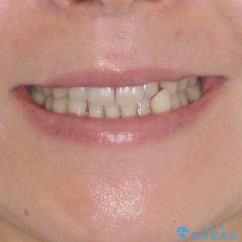 八重歯のインビザライン矯正治療の治療前(顔貌)