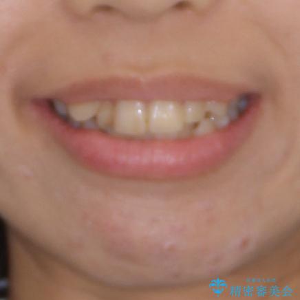 上下の八重歯を治したい　インビザラインと補助装置を用いた抜歯治療の治療前（顔貌）