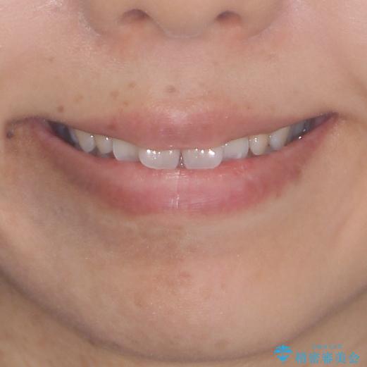 全く目立たないワイヤー矯正 上下リンガル矯正の治療前(顔貌)