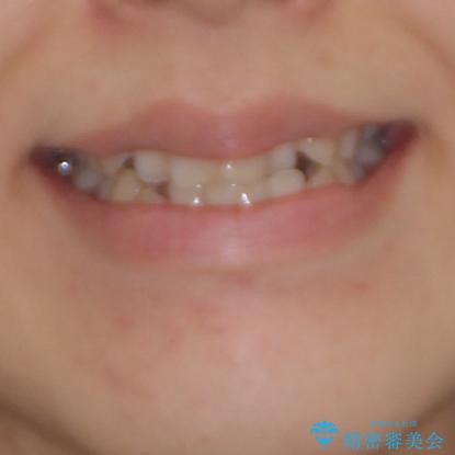 前歯のクロスバイトを治したい　インビザラインによる矯正治療の治療前（顔貌）