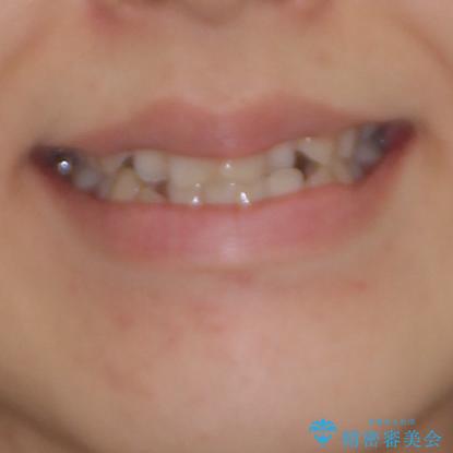 前歯のクロスバイトを治したい インビザラインによる矯正治療の治療前(顔貌)