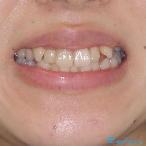 狭い上顎骨を拡大　インビザラインによる非抜歯矯正の治療前（顔貌）