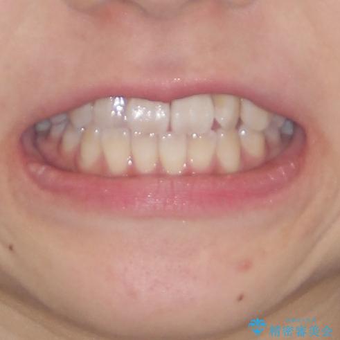 気になる前歯のデコボコ　インビザラインによる矯正治療の治療前（顔貌）