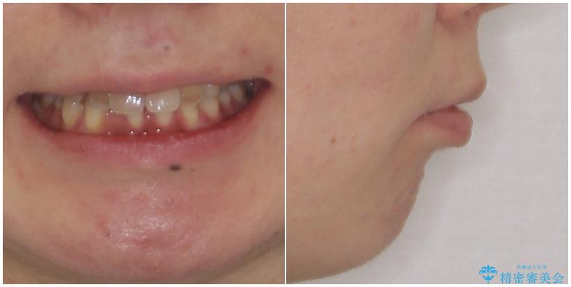 閉じにくい口元　前歯を引っ込める抜歯矯正の治療前（顔貌）