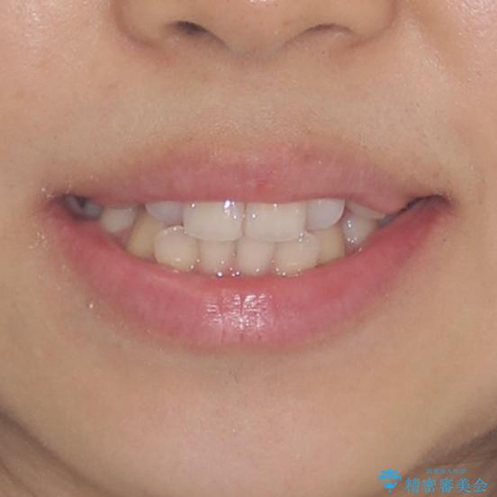 前歯の突出感とデコボコ　インビザラインで改善の治療前（顔貌）