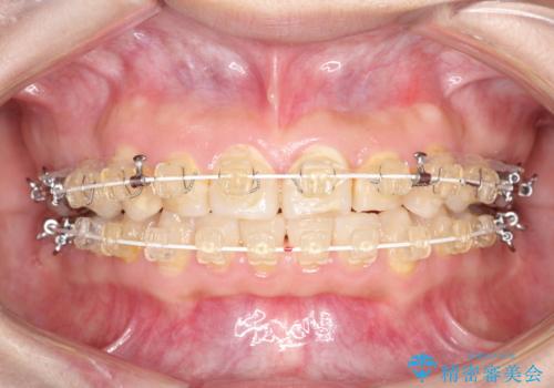 【ワイヤー矯正】前歯が出てるのをなおしたい。の治療中
