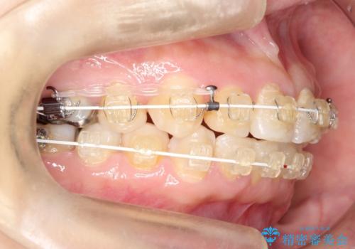 【ワイヤー矯正】前歯が出てるのをなおしたい。の治療中