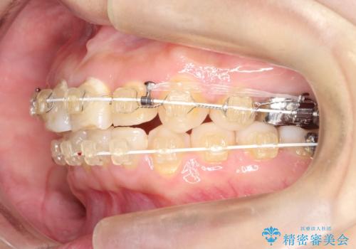 【ワイヤー矯正】前歯が出てるのをなおしたい。の治療中
