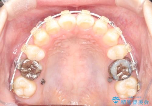 【ワイヤー矯正】前歯が出てるのをなおしたい。の治療中