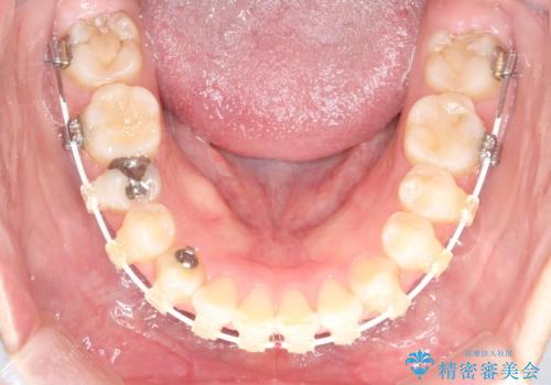 【ワイヤー矯正】前歯が出てるのをなおしたい。の治療中