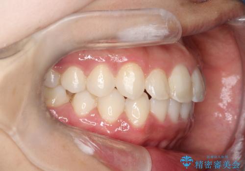 【非抜歯矯正】できる限り前歯を引っ込めたいの治療後