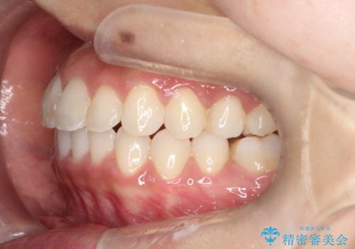 【非抜歯矯正】できる限り前歯を引っ込めたいの治療後