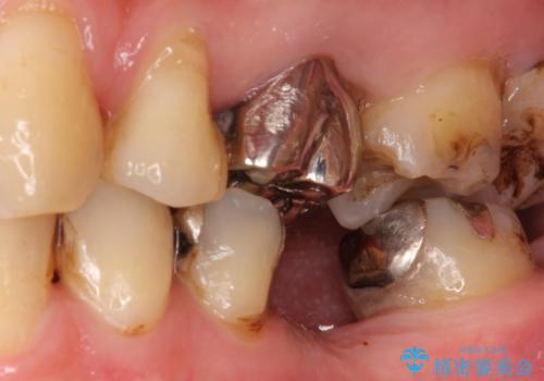 奥歯で噛めるようになりたい。オールセラミッククラウンブリッジの治療前