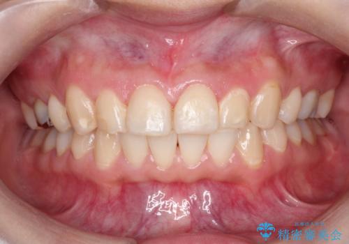 【ワイヤー矯正】前歯が出てるのをなおしたい。の治療後