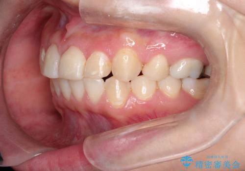 【ワイヤー矯正】前歯が出てるのをなおしたい。の治療後